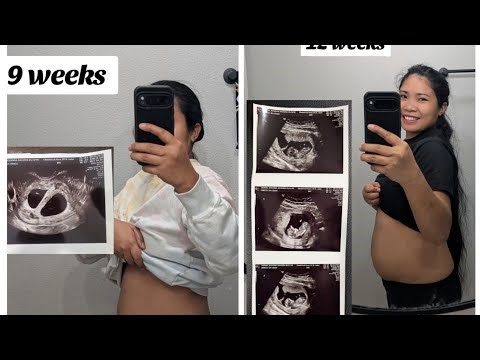 12-week Di/Di twin ultrasound