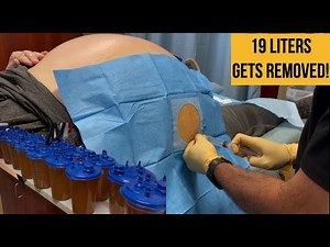 19 liters of fluid out of the belly of this patient