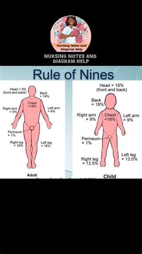 Nursing Notes and Diagram Help on Instagram: "Rule of Nine of Burn Follow @nursingnotesanddiagramhelp #burn #ruleofnines #nursingnotesanddiagramhelp #nursing #medical"