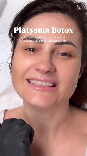 Platysma Botox is a non-surgical treatment that relaxes the neck’s vertical muscle bands, creating a smoother, more defined jawline and elegant neck contour. By carefully injecting Botox into the platysma muscle, the tension that pulls the lower face downward is reduced — resulting in a lifted, rejuvenated appearance. | Elena Martin
