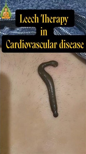 Leech therapy in Cardiovascular Diseases #leechtherapy
