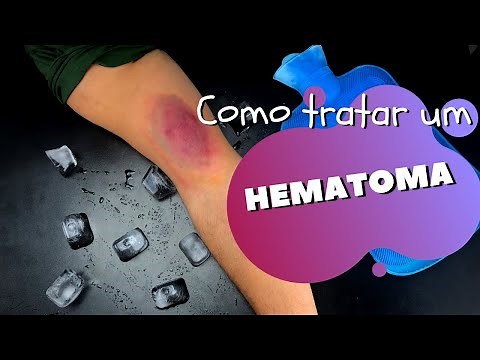 Como tirar hematomas do corpo? - O que fazer e como tratar Contusão