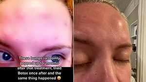 Botox gave me gumball-sized lumps all over my forehead that won't go away...