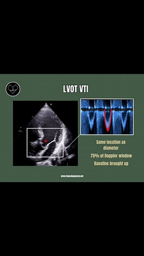 44K views · 275 reactions | LVOT VTI (V₁) The LVOT velocity–time...