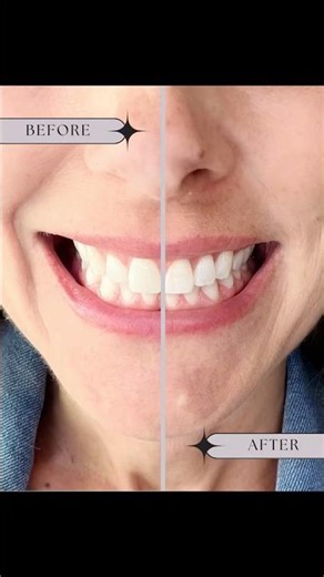How to whiten your teeth in 30 minutes with Lumineux strips #teethwhitening #tutorial #howto