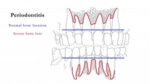 Periodontitis Animated Diagram