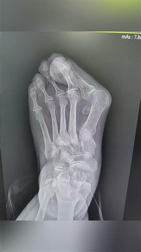 Minimally invasive bunion surgery, no internal fixation required and no second operation needed