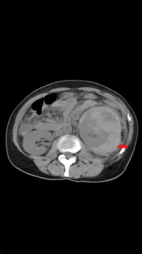 Grey Turner's sign is bruising of the flanks caused by retroperitoneal bleeding. It is most commonly associated with severe acute pancreatitis but can also occur with abdominal trauma, ruptured abdominal aortic aneurysm, and other causes of internal hemorrhage.Read: https://t.co/6NnW6HaKGY#Trauma #ClinicalSkills #EmergencyMedicine #PhysicalExam #MedicalEducation