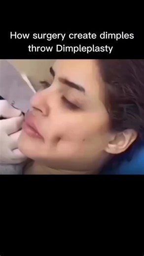 Education on Instagram: "Ever wondered😍 how some people are born with dimples while others get them with surgery? 👩‍⚕️✨ This reel breaks down how dimpleplasty (dimple surgery) actually creates that natural-looking dimple when you smile.In this video, you’ll learn:What a natural dimple is: a small depression created by a difference in the cheek muscle structure.How a surgeon designs the dimple: choosing the ideal point based on your facial anatomy and smile line.The surgical technique:A tiny in