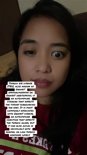 Thyroid eye disease (TED), also known as Graves' ophthalmopathy or Graves' orbitopathy, is an autoimmune disorder that affects the tissues surrounding the eyes. It is most commonly associated with Graves' disease, an autoimmune condition that affects the thyroid gland, but it can also occur in individuals with normal or low thyroid hormone levels .##thyroidproblems ##thyroiddisease##thyroidhealing