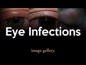 Eye Infections: Image Gallery