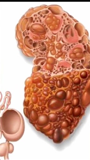 what is kidney cyst and it's types