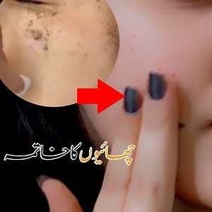 Freckles removal homemade gel | چھائيوں کا خاتمہ #freckles #frecklesremoval #skincare #homeremedies #shumaila #skinglow #shumailasdiary | Shumaila's Diary