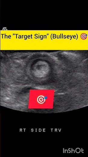 Why is there a TARGET inside the stomach? 🎯💀 (Intussusception) #shorts#radiology #educational.