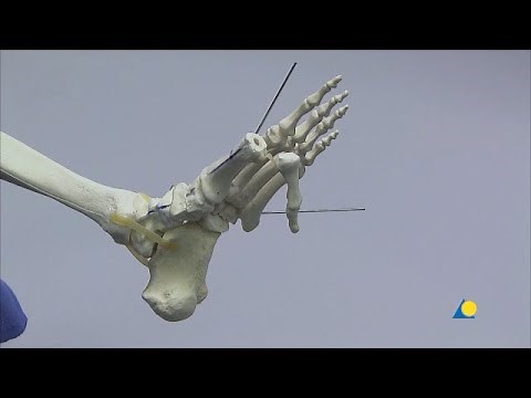Midfoot - Profound Collapse or Instability - Reconstruction and Realignment With Midfoot Fusion Bolt