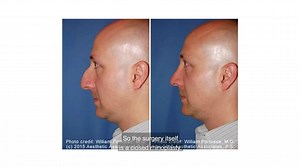 Rhinoplasty to Remove a Dorsal Hump on The Nose