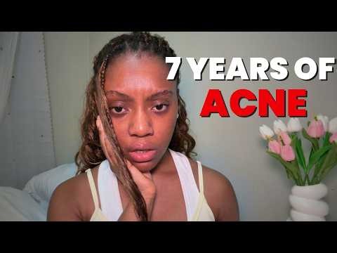 How I Cleared My Acne After 7 Years (What Actually Helped)