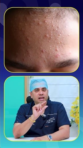 What Is Comedonal Acne? | Causes & Types of Acne Explained | #ytshorts #healthtips #acne #acnecauses