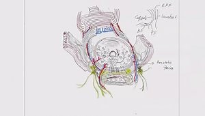 Robot-Assisted Radical Prostatectomy: Surgical Techniques and Sexual Recovery