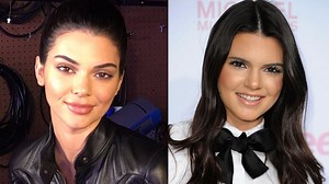 “It Doesn’t Make Sense”: Kendall Jenner Denies Having Lip Fillers & Facial Surgery