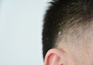 Laser Wart Removal Treatment