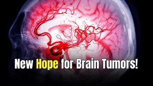 New drug combination boosts life expectancy from grade 3 brain tumors by 45% or more