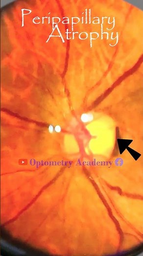 Peripapillary Atrophy | Diabetic retinopathy | Fundus | Short Video 353