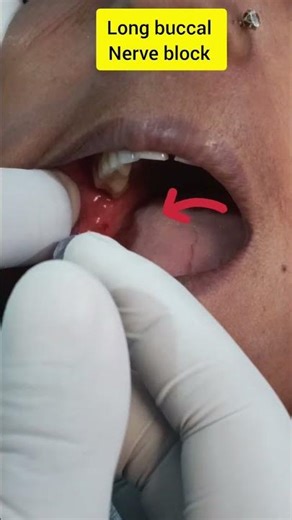 Injection for long buccal nerve #shorts