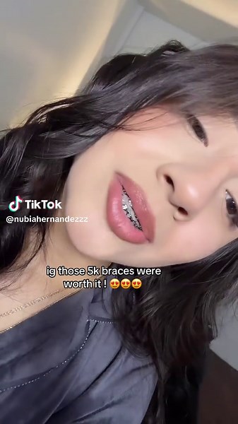 My Perfect Teeth After $5k Braces - Worth It! 😇