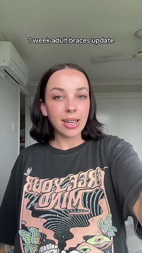 Adult Braces Journey Update: 1 Week Progress