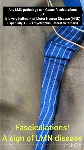 Fasciculations : A Sign of LMN disease|‪@Dr.KamaleshTN_MediCal_Lectures‬ #mnd #als #anteriorhorncell