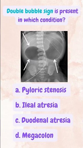 Double bubble sign is an ultrasonographic finding in duodenal atresia & is associated with trisomy21