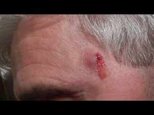 Parasite worm Dirofilaria Repens,Fadenwurm,exiting the Head alive !