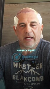 Best Hair Transplant Experience | BlueMagic Group