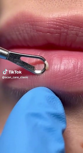 Remove Blackheads from Lips Safely & Effectively