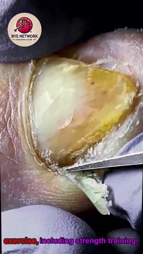 8.7K views · 46 reactions | Gentle Nail Care for Thick Toenails with Gentle Daily Routine #ToenailSupport #HomeNailCare #SafeNailCare | Bye | Facebook