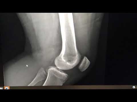 How to read a KNEE X-ray (Chondromalacia Patella/Swelling)