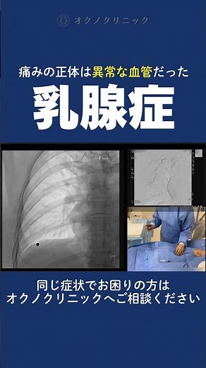 痛みの正体は異常な血管だった乳房の痛み 乳腺症