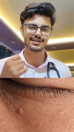 Dr. Aavishkar Raj Regmi on Instagram: "Common warts are caused by the Human Papilloma Virus (HPV) and usually appear on the hands, fingers, around nails, or feet. They are small, rough, hard bumps that are generally painless. The virus spreads through direct skin contact or by sharing contaminated items like towels or razors. Avoid picking or cutting the wart. Treatment options include cryotherapy, laser, or topical medicines as advised by a doctor. Maintain good hygiene and avoid spreading it t