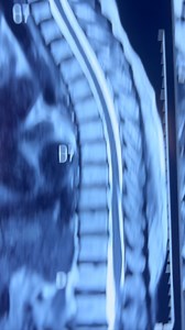 Struggling with low back pain from a disc prolapse? 💥 Watch this quick educational video to understand the causes, symptoms, and tips for relief! 🩺 #BackPainRelief #DiscProlapse #HealthTips #stayactive | Dr RR Jain