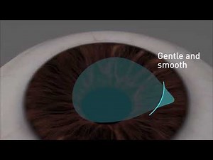 SmartSight Laser Eye Surgery - Schwind ATOS Lenticule extraction