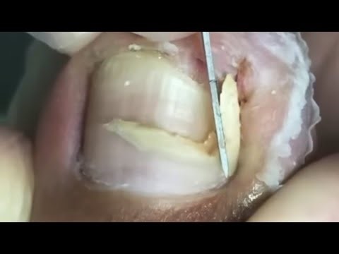 The Toe That Was Damaged By The Ingrown Nail, The Wound Is Full Of Toxins