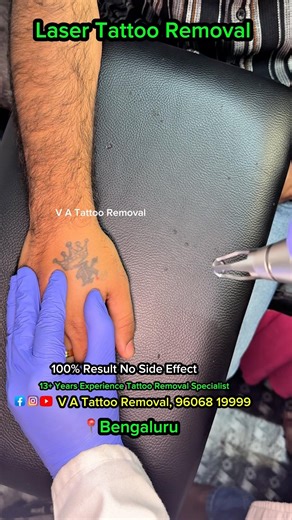 Tattoo Removal Laser Treatment Bengaluru |100% Result No Side Effect | #tattooremoval #laser #viral