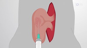 Video: Intracecal Tumor Cell Injection: A Technique to Deliver Cancer Cells for Establishing Orthotopic Colorectal Cancer Mouse Model - Experiment