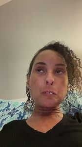 4.1K views · 404 reactions | A few jumbled thoughts at the end of a long day. Happy Scleroderma Awareness Month? Scleroderma patient 16 years and counting. #sclerodermastrong | Scleroderma Strong | Facebook