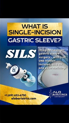Single incision gastric sleeve. SILS