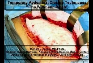 Wittmann Patch abdominal closure without TAWT