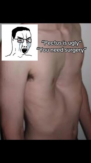 Fix Pectus Without Surgery: Muscle Building Guide