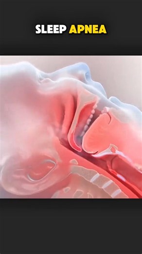 Sleep Apnea Explained in 60 Seconds! 😴😮 #healthcare #anatomy