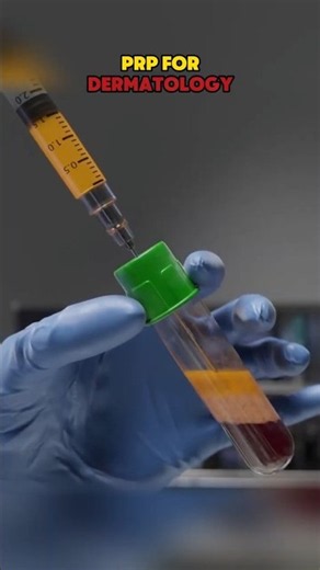 How PRP Treatment Is Performed | Platelet Rich Plasma in Dermatology #shorts #shortvideos #prp